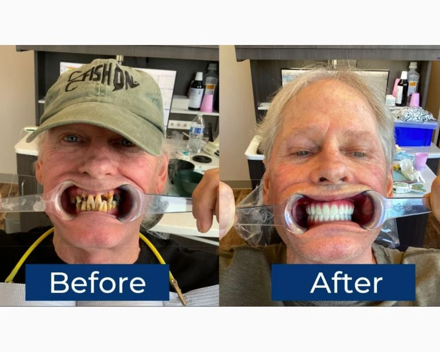 The Ultimate Guide To Full Mouth Dental Implants